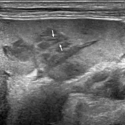 The Role of Contrast-Enhanced Ultrasound in Differentiating Splenic Tuberculosis From Splenic Lymphoma